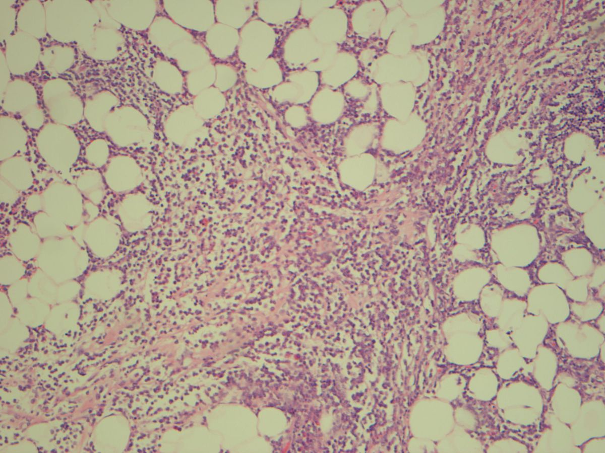 Small bowel myeloid sarcoma (H&E 200X)